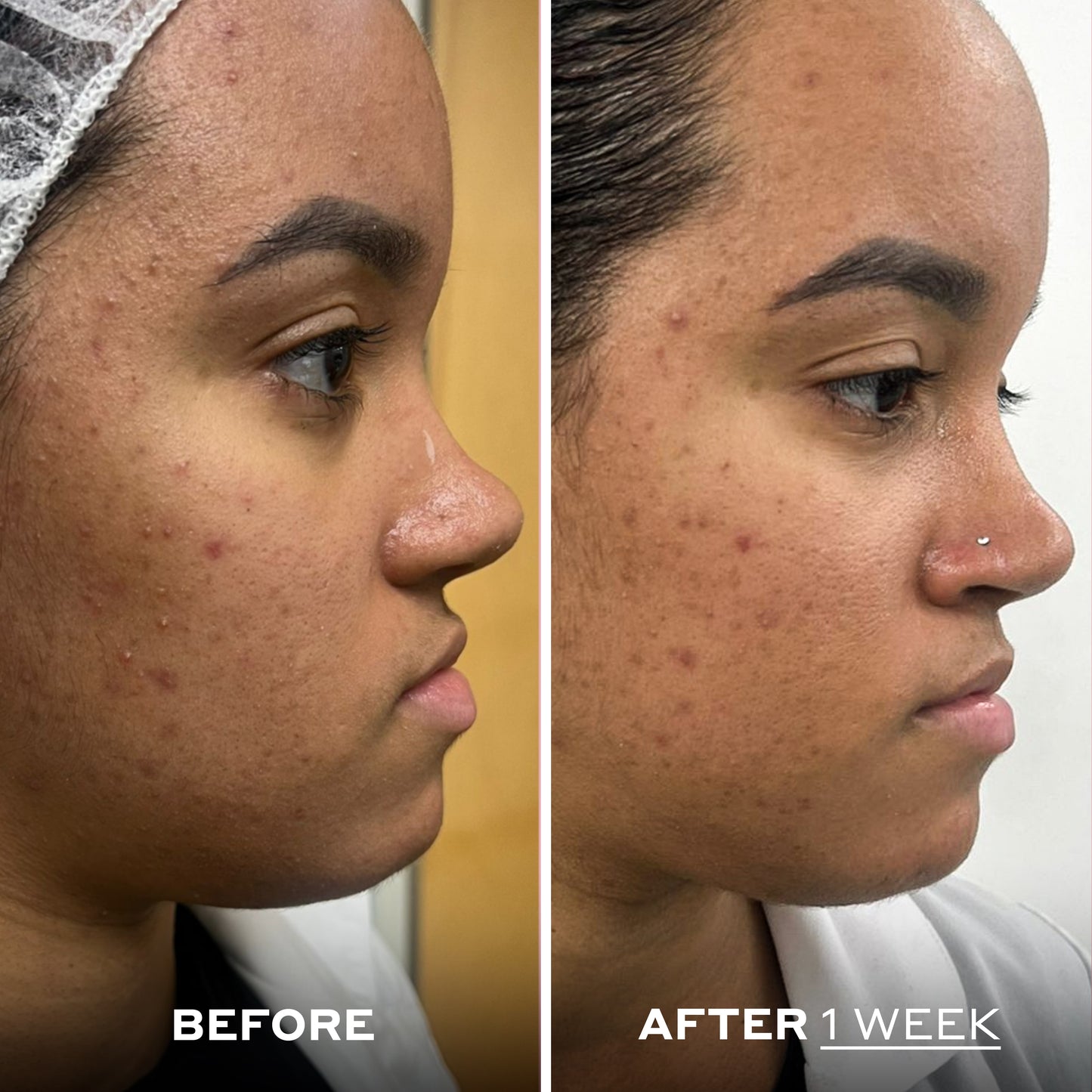 Skin Perfecting Balm with Salicylic Acid