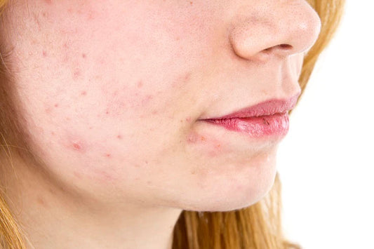 What Is Post-Inflammatory Hyperpigmentation?