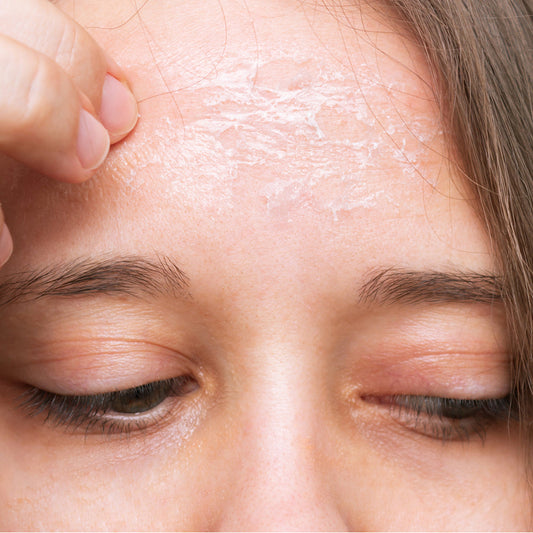 SKINCARE ESSENTIALS, LESSON #2: WHAT IS DRY SKIN?