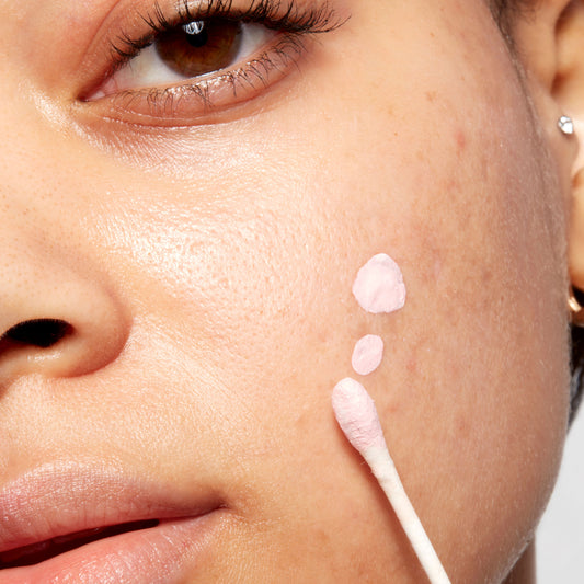 Unbeatable Acne Breakouts In The Same Spot? Find Out Why!