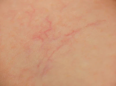 The Truth about Broken Capillaries (AKA “Spider Veins”) on the Face