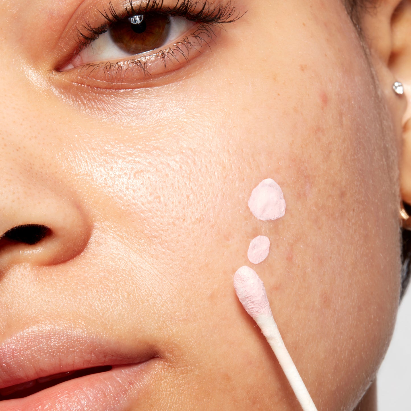 Woman showing how to apply Drying Lotion to skin using a Q-Tip